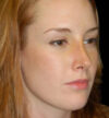 Rhinoplasty case #13110