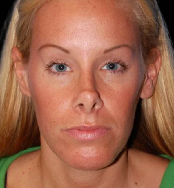 Revision Rhinoplasty case #13387