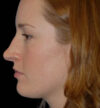 Rhinoplasty case #13110