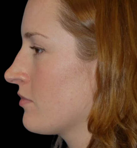 Rhinoplasty case #13110