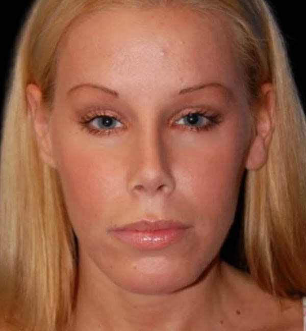 Revision Rhinoplasty case #13387