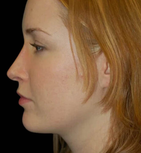 Rhinoplasty case #13110