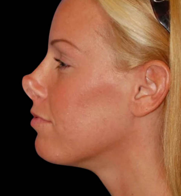 Revision Rhinoplasty case #13387