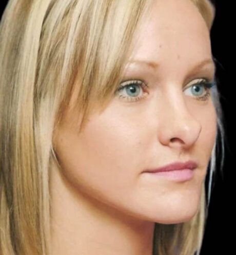 Rhinoplasty case #13103