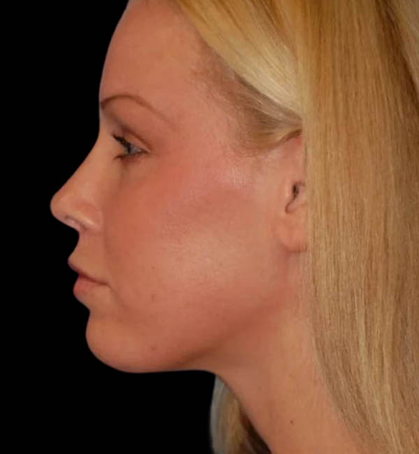 Revision Rhinoplasty case #13387