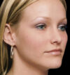 Rhinoplasty case #13103