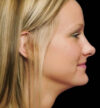 Rhinoplasty case #13103
