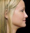 Rhinoplasty case #13103