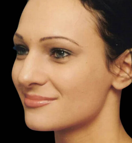 Rhinoplasty case #13097