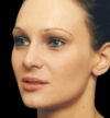 Rhinoplasty case #13097