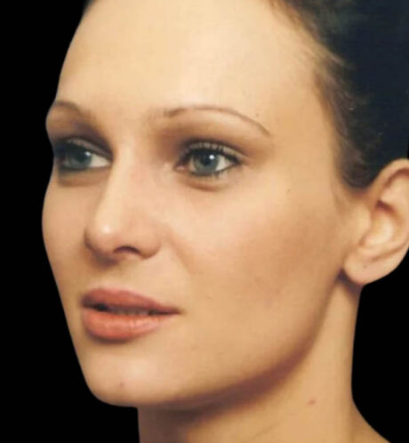 Rhinoplasty case #13097