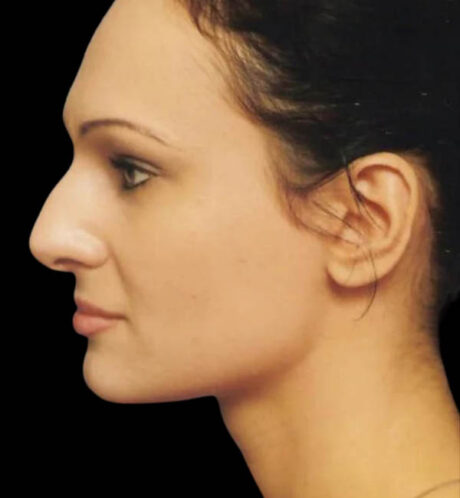 Rhinoplasty case #13097