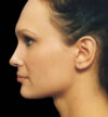 Rhinoplasty case #13097