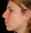 Rhinoplasty case #13071