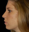 Rhinoplasty case #13071
