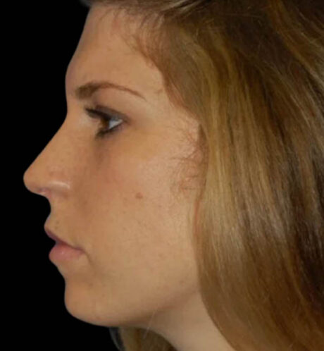 Rhinoplasty case #13071
