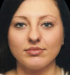Rhinoplasty case #12902