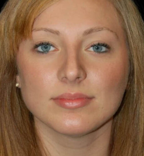 Rhinoplasty case #12902