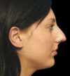 Rhinoplasty case #12902