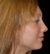 Rhinoplasty case #12902