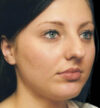 Rhinoplasty case #12902