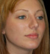 Rhinoplasty case #12902