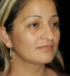 Rhinoplasty case #12889