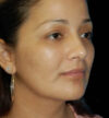 Rhinoplasty case #12889