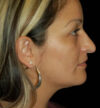 Rhinoplasty case #12889