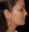 Rhinoplasty case #12889