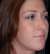 Rhinoplasty case #12884