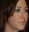 Rhinoplasty case #12884