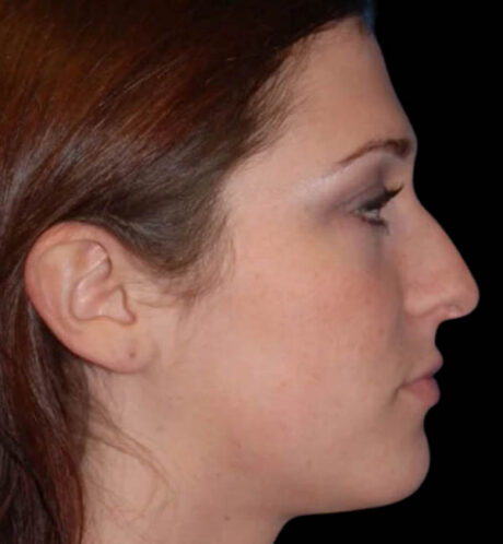 Rhinoplasty case #12884