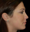Rhinoplasty case #12884