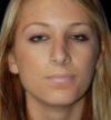 Rhinoplasty case #12829