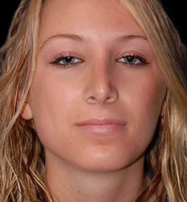 Rhinoplasty case #12829