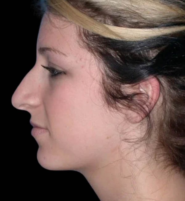 Rhinoplasty case #12829