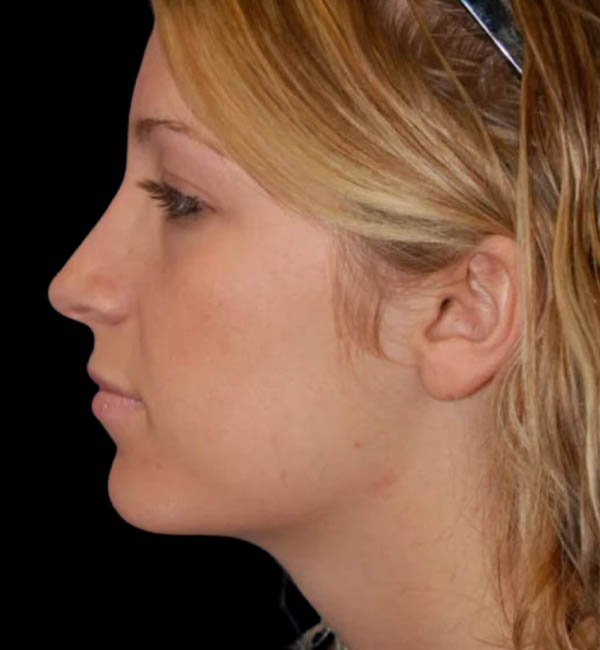 Rhinoplasty case #12829