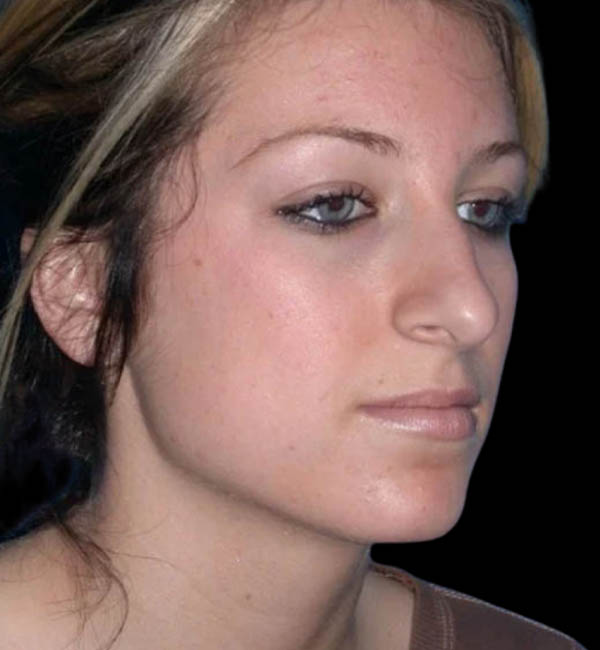 Rhinoplasty case #12829