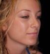 Rhinoplasty case #12829