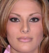Rhinoplasty case #12808