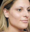 Rhinoplasty case #12808