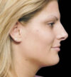 Rhinoplasty case #12808