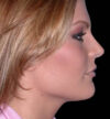 Rhinoplasty case #12808