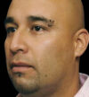 Rhinoplasty case #12803