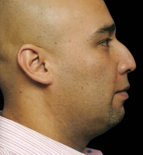 Rhinoplasty case #12803