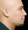 Rhinoplasty case #12803