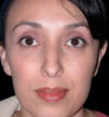 Rhinoplasty case #12754