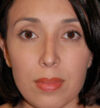 Rhinoplasty case #12754