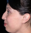 Rhinoplasty case #12754